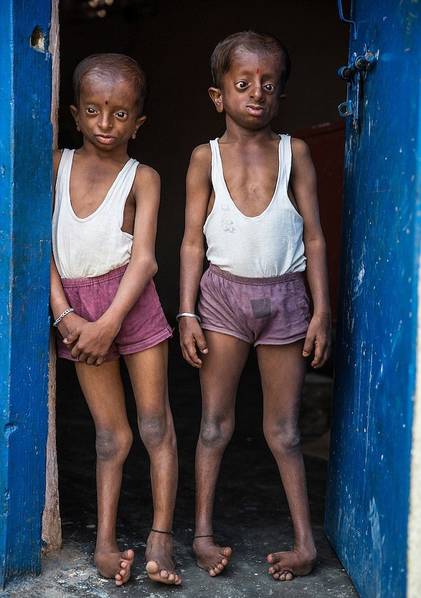 印度兩兄弟身患怪病摸樣異于常人不敢出門