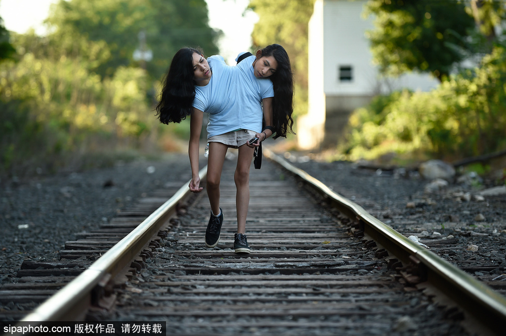 美國(guó)16歲連體姐妹拒做分離手術(shù) 她們的決定讓人無(wú)法理解