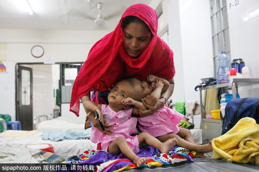 孟加拉國連頭嬰兒 至少到兩歲才能進行手術