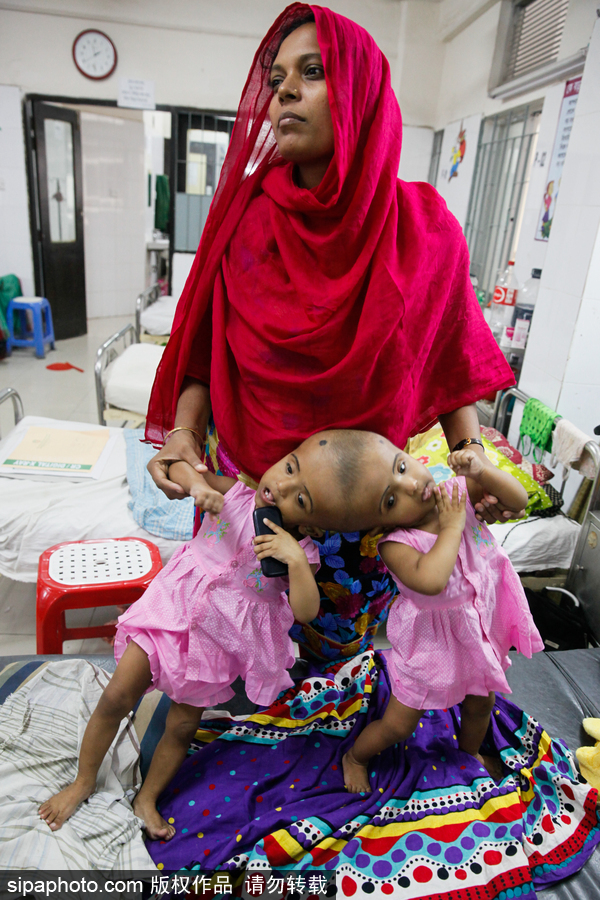 孟加拉國連頭嬰兒 至少到兩歲才能進行手術